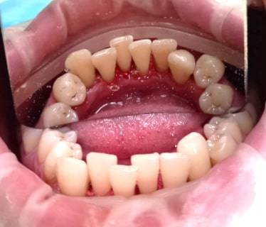 Профгигиена зубов