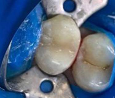 Лечение глубокого кариеса зуба