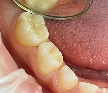 Лечение кариеса молочных зубов – До