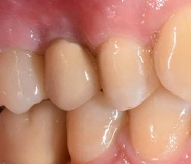 Восстановление зуба цельнокерамической коронкой
