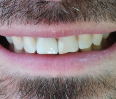 Восстановление зуба коронкой из прессованной керамики Emax
