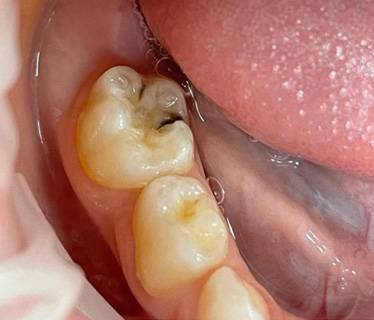 Лечение кариеса молочных зубов – До