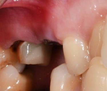 Восстановление зуба цельнокерамической коронкой
