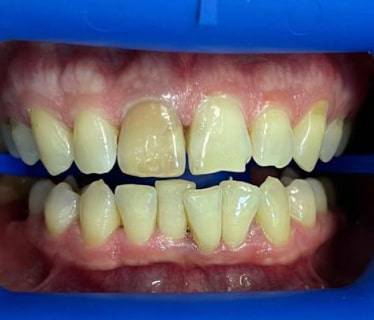 Восстановление зуба коронкой из прессованной керамики Emax