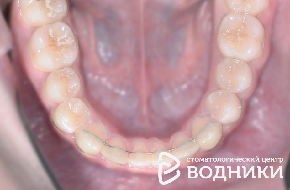 Исправление прикуса зубов Водники
