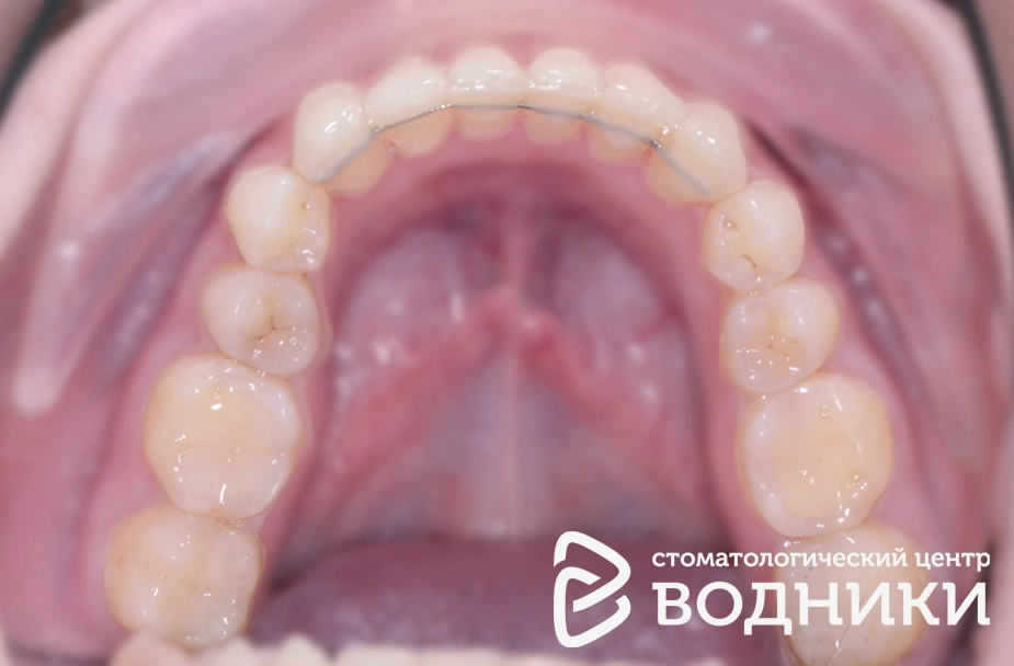 Исправление прикуса детям Водники