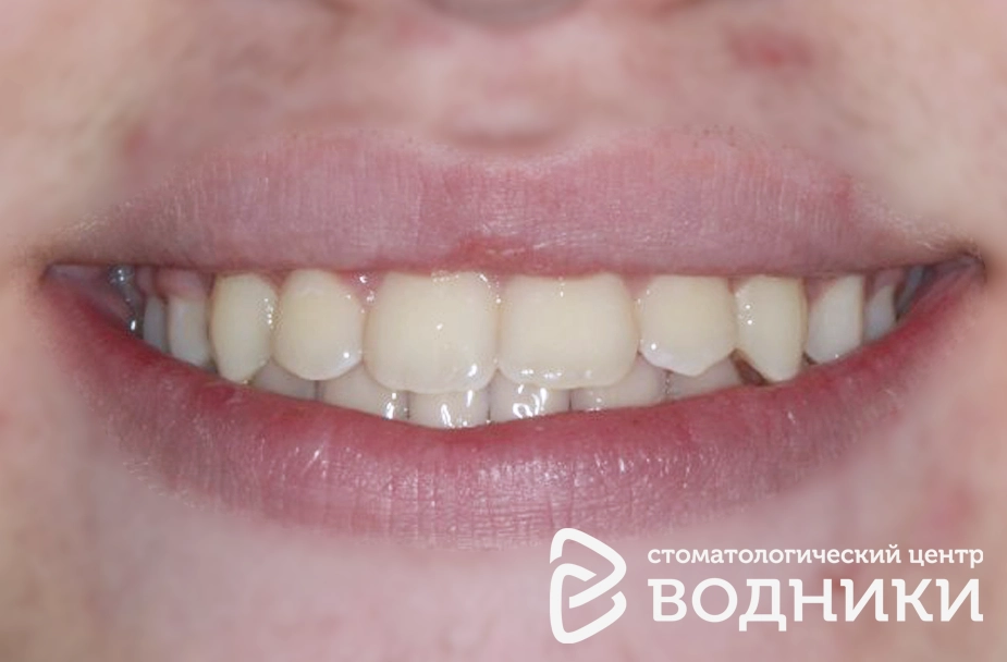 Выравнивание зубов детям Водники