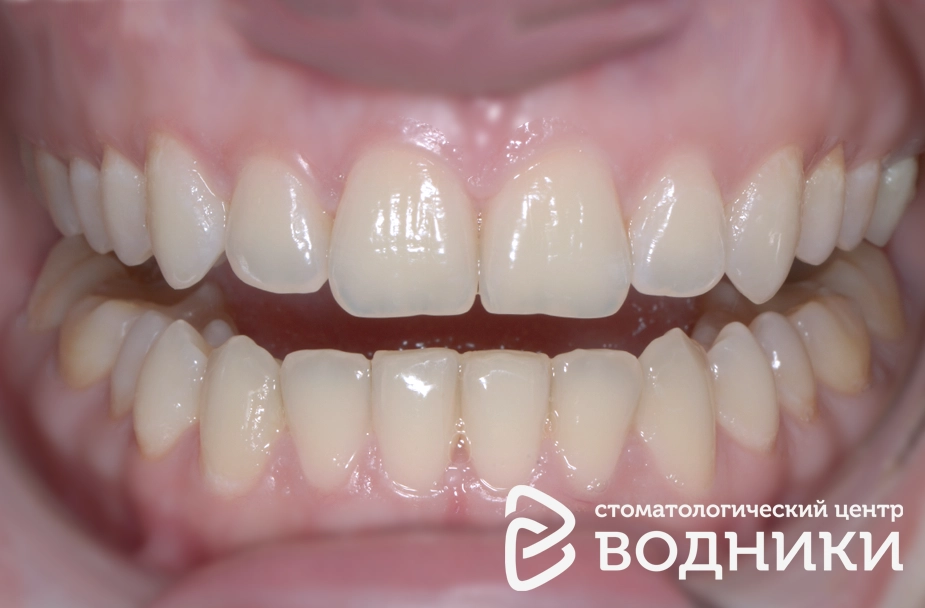 Выравнивание зубов детям Водники